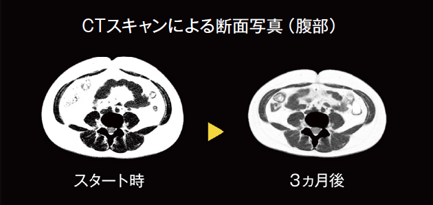CTスキャンによる断面写真（腹部）